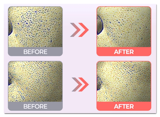 Hongdae Lituo vs. Rejuran Comparison: Effects, Pain, and How Long They Last image 6