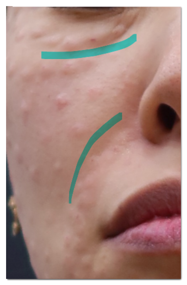 Why People Say Rejuran Is Ineffective Without Embossing image 7