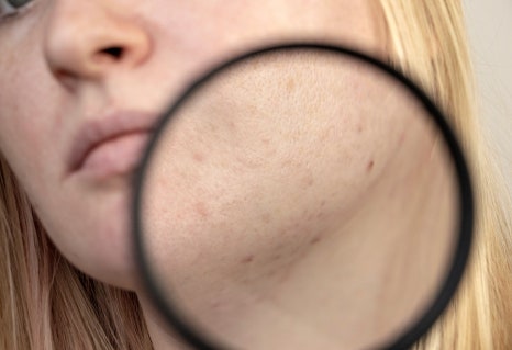 홍대피부관리 모공과 탄력 고민, 쥬베룩과 아피니트로 해결하세요 관련 이미지 3