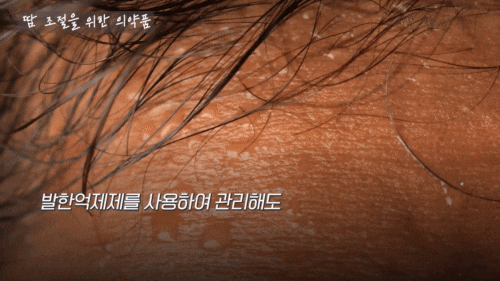 Hongdae Botox for Those Worried About Summer Hyperhidrosis image 11
