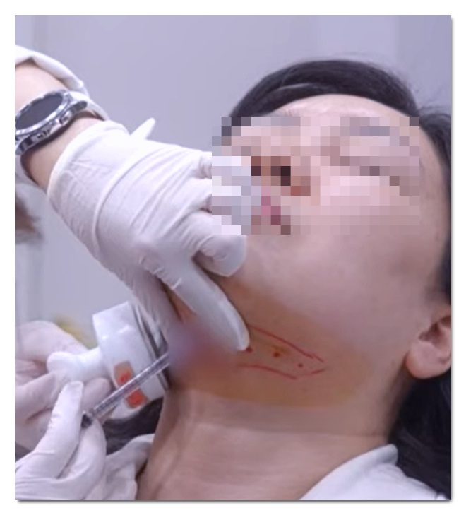 Why You Shouldn’t Get Contour Injections Anywhere in Hongdae image 3