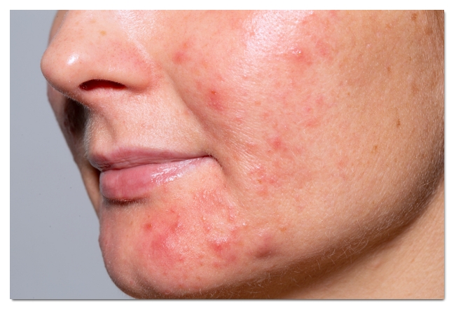 How to Get Acne Steroid Injections Effectively in Hongdae image 3
