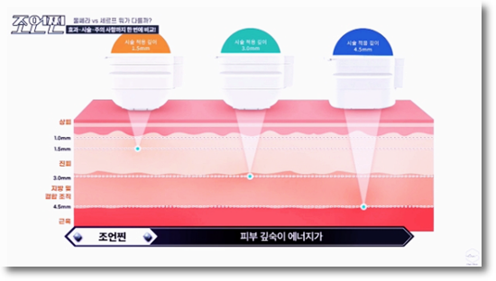 합정 울쎄라 잘하는 곳은 이것이 다릅니다 관련 이미지 3