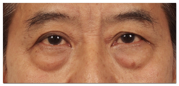 Differences and Effect Comparison Between Eye Thermage and Eye Ultherapy image 8