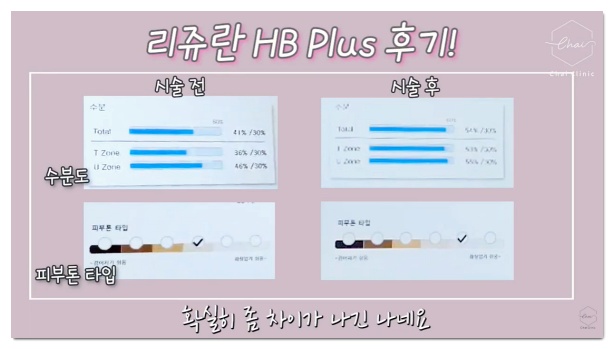 홍대 리쥬란 맞았는데 효과 없었던 분들 꼭 보세요 관련 이미지 11