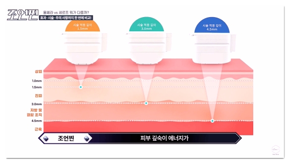 홍대 울쎄라 덜 아프고 효과 좋게 받는 방법 (수면마취 아님) 관련 이미지 2