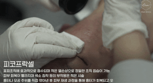 피코프락셀 주기와 관리 방법 차이에서 알려 드려요 관련 이미지 4