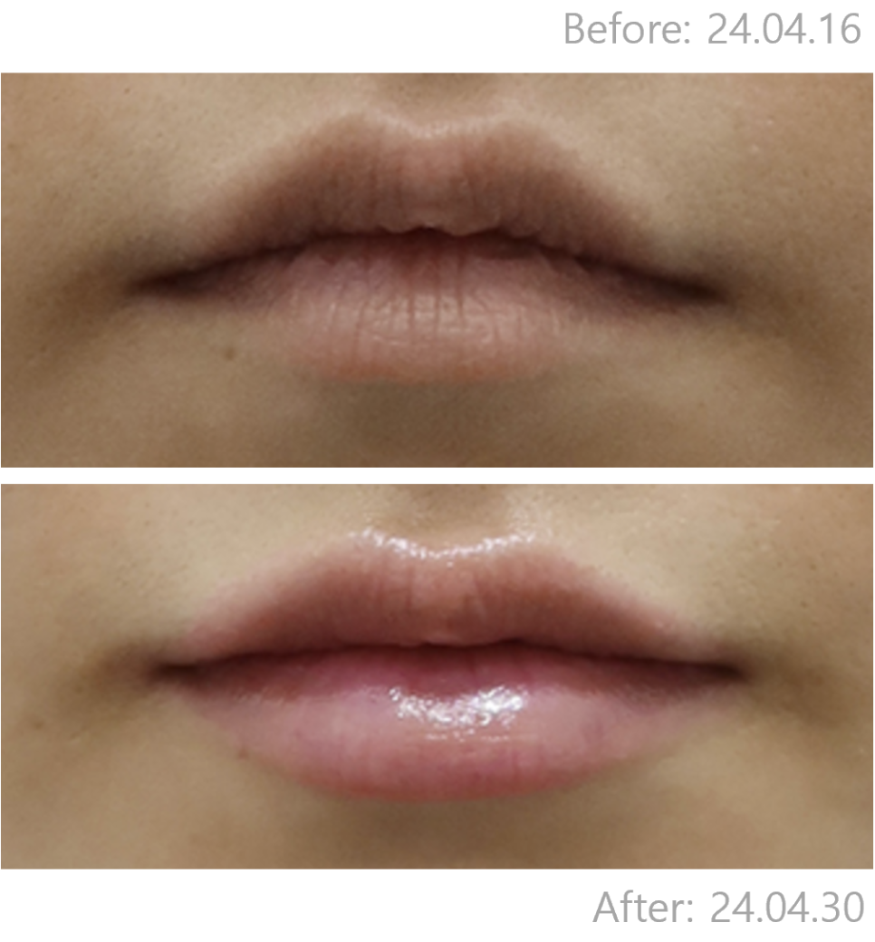 Hongdae Lip Filler: A Complete Guide to Pain, Swelling, and Design Before and After image 6