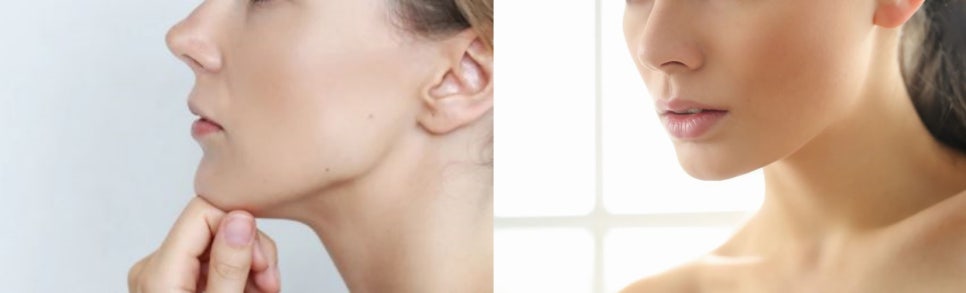 사각보톡스 불룩한 턱선을 V라인 얼굴로 관련 이미지 6