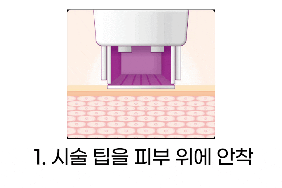 연남동 써마지, 탁월한 주름 개선을 원하는 20~50대 여성들이라면? 관련 이미지 4