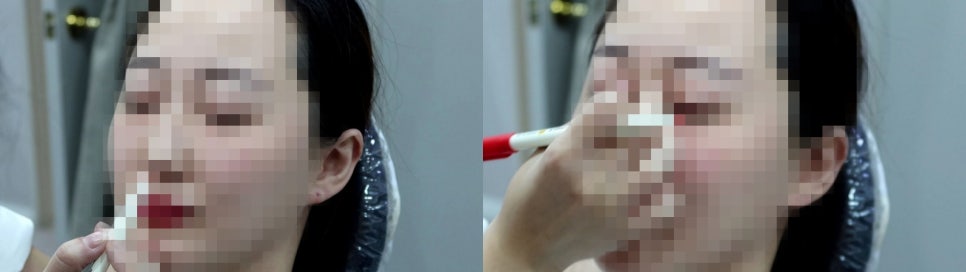 보톡스 종류 국산과 수입? 현명한 선택하려면 필독 관련 이미지 6