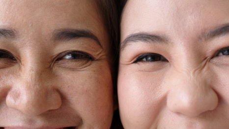 합정코조각주사 뭉툭한 복코도 슬림하게! 관련 이미지 3
