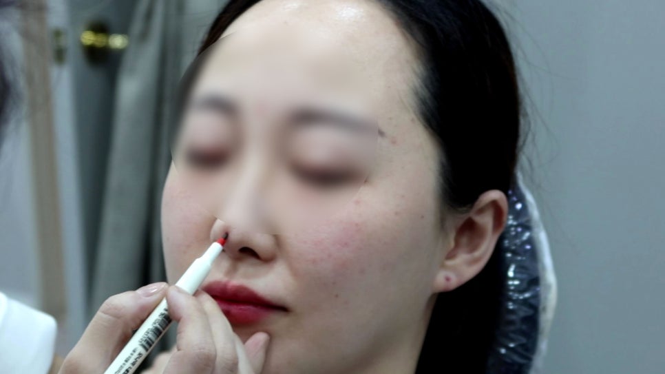 홍대 코실리프팅 밋밋한 코가 고민이라면 필독! 관련 이미지 6