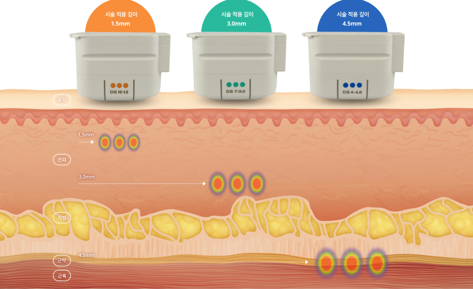 울쎄라 잘하는 곳엔 특별한 &lsquo;이것&rsquo;이 있습니다 관련 이미지 6