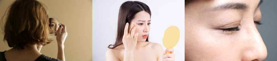 눈밑처짐수술, 수술없이 실리프팅 가능해요 관련 이미지 1