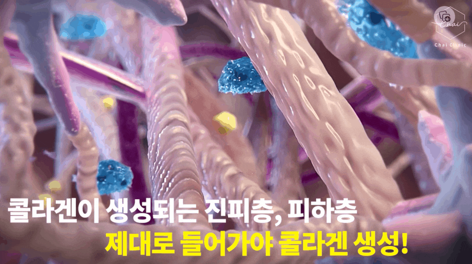 얼굴형시술 갸름하고 예쁜 브이라인 만들기 관련 이미지 5