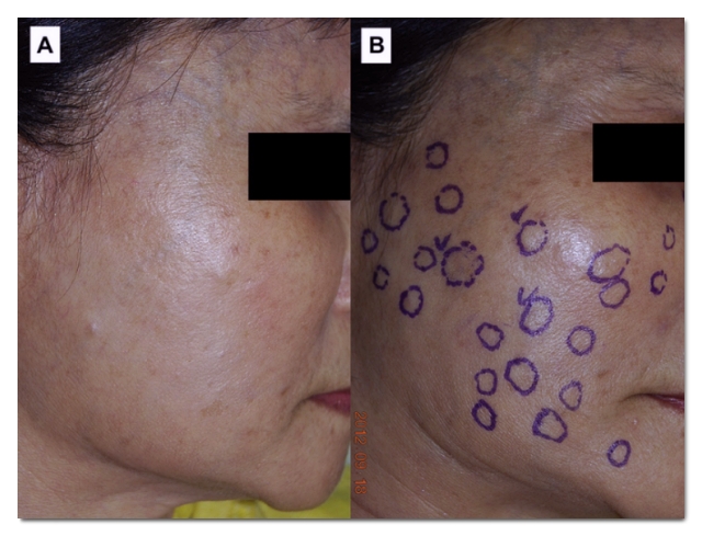 The 233 Rule for Reducing Sculptra Nodule Side Effects in Hongdae image 5
