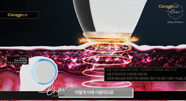 V라인리프팅 후기만 보고 결정하지 마세요! 관련 이미지 12