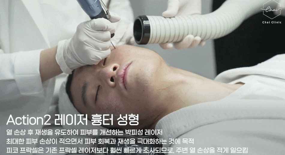 합정 나비존 프락셀 스트레스였던 모공 해결하기 관련 이미지 7