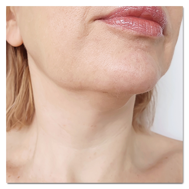 3 Things to Know to See Results from Thermage in Hongdae image 8