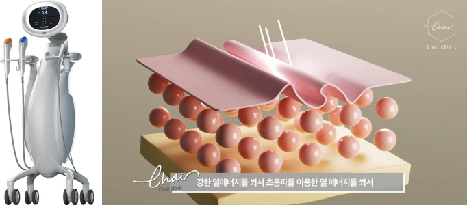 눈리프팅 효과를 120% 더 낼 수 있는 시술 대공개! 관련 이미지 10