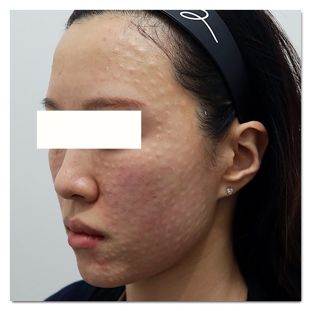 홍대 리쥬란 맞았는데 효과 없었던 분들 꼭 보세요 관련 이미지 6