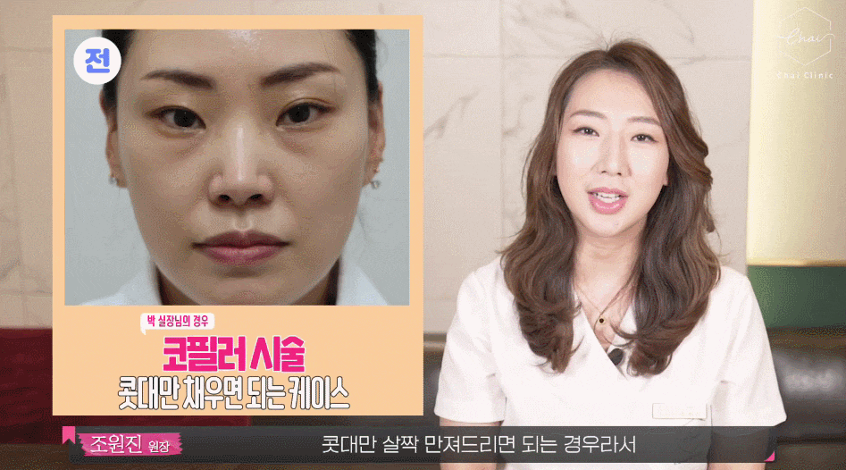 남자코필러, 콧대 각도 높이는 강력한 방법 관련 이미지 4