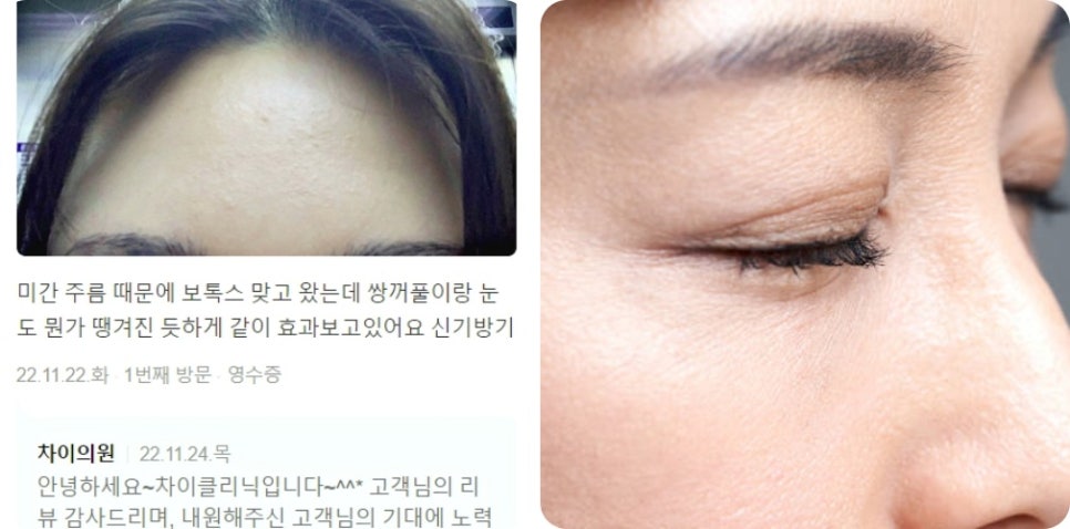 V라인 리프팅, 관련 이미지 14