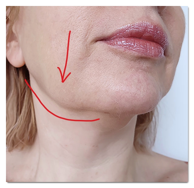 3 Cases Where You’ll Regret Masseter Botox in Hongdae image 5