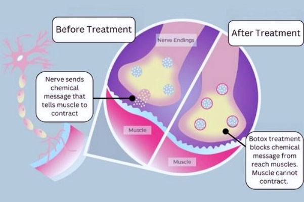 Xeomin German Botox or Domestic Botox? How to Choose image 2