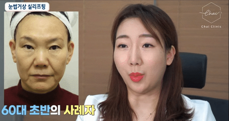 실리프팅후붓기 기간과 눈썹 OO 효과까지 알아보기 관련 이미지 4