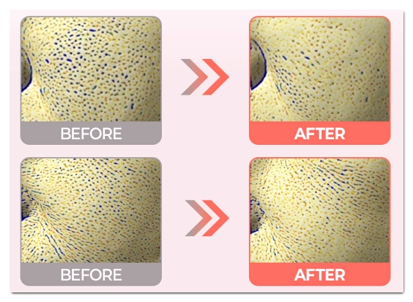 How to Effectively Receive Rituo Treatment in Hongdae for Improving Fine Lines and Pores image 6