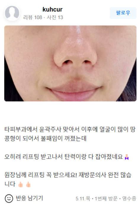 V라인리프팅 후기만 보고 결정하지 마세요! 관련 이미지 20