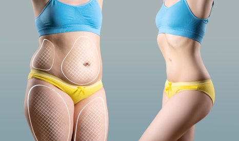 바디윤곽주사로 3년치 군살 확 빼는 방법 관련 이미지 2