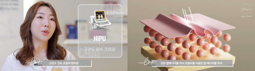 울쎄라 병원 , 헤메지 말고 차이에서! 관련 이미지 3