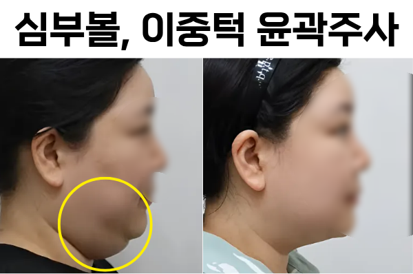 How to Get Contour Injections for Buccal Fat and Double Chin in Hongdae image 6