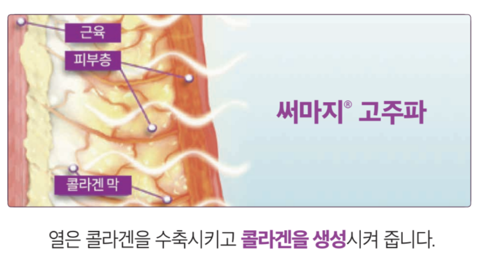 고주파 리프팅 종류와 차이의원의 리프팅 솔루션 관련 이미지 11