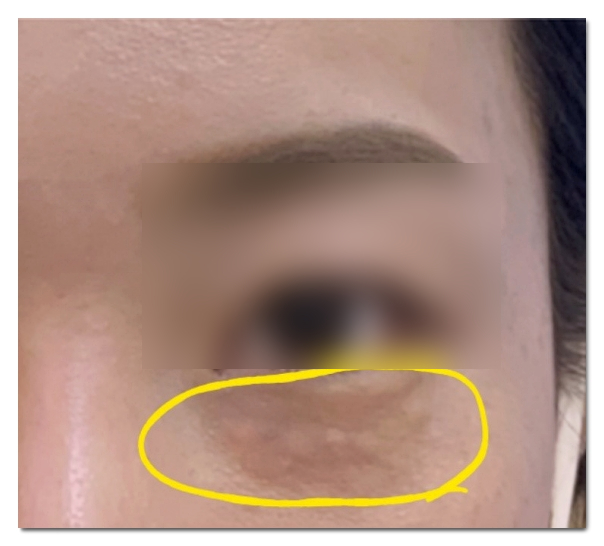 합정 쥬베룩, 결절 걱정없이 효과 보는 방법 (경험 많은 곳을 찾아야 하는 이유) 관련 이미지 2