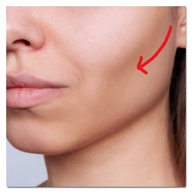 Ulthera Effects, How It Works, Side Effects After Treatment, and Prevention image 5
