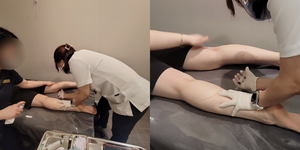 종아리보톡스 슬림한 다리 라인 원한다면! 관련 이미지 8