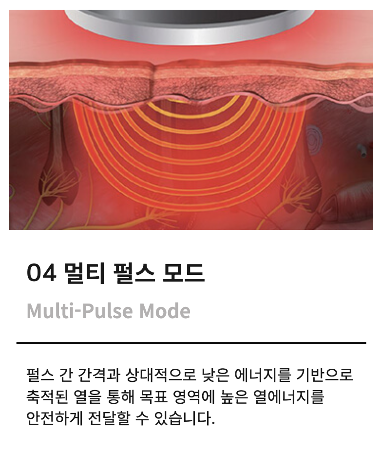 토르 리프팅과 슈링크 유니버스의 병행 시술, 차이핏 리프팅 관련 이미지 6