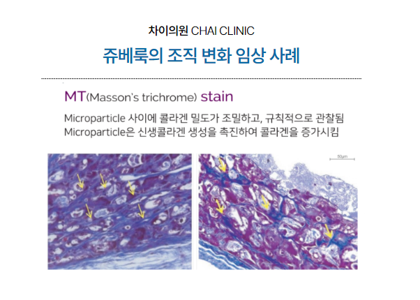 여드름 흉터 레이저, 피코프락셀과 같이 하면 좋은 것은? 관련 이미지 4
