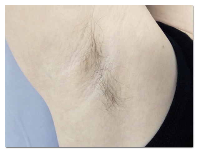 Why Underarm Laser Hair Removal in Hongdae Can Be Ineffective Even After 20 Sessions image 2