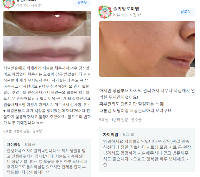 입가주름보톡스 알고 맞으면 효과 2배! 관련 이미지 18