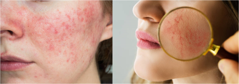 여드름흉터 시술 관련 이미지 3