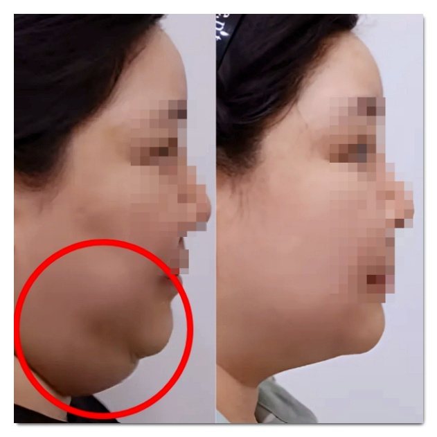 이중턱살 주사 무엇을 맞을까? 윤곽주사, 지방분해주사 선택법 관련 이미지 2