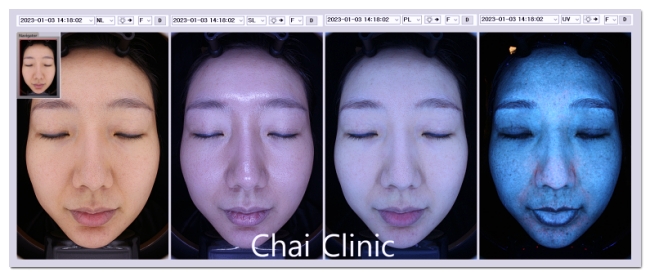If You Don’t Want to Waste Money on Hongdae Pico Toning, Look at These 3 Things image 4