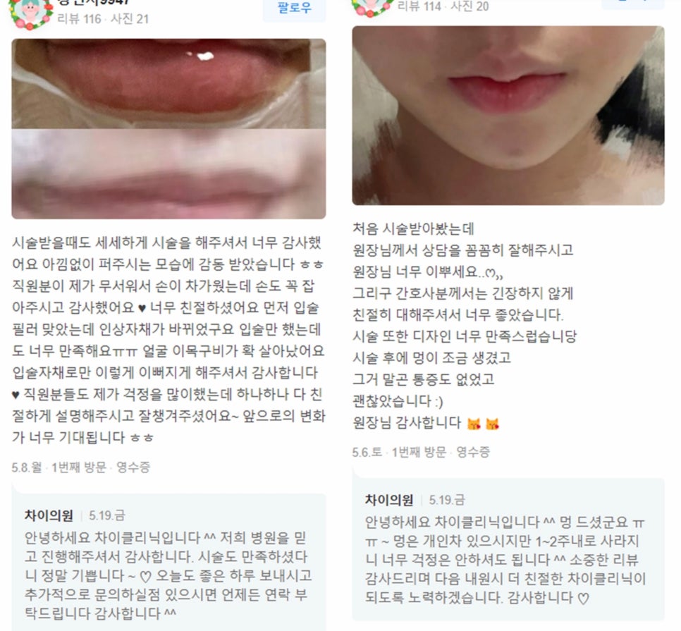 홍대피부관리 입술필러, 본인 이미지에 맞는 입술은 뭘까? 관련 이미지 14