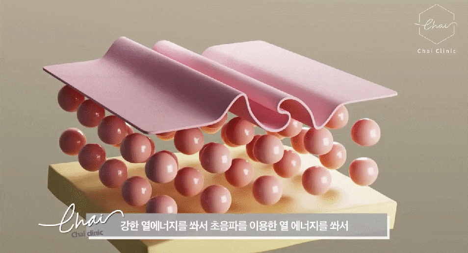 남자리프팅 효과 관련 이미지 5