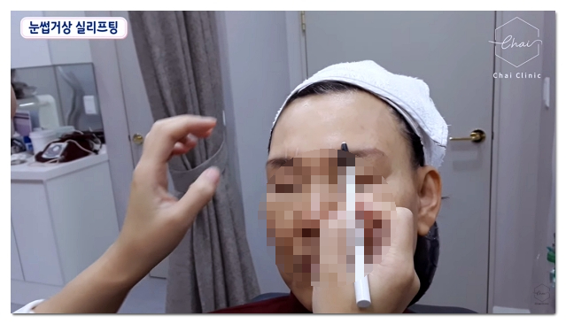 Causes of and Solutions for Side Effects After Thread Lifting in Hongdae image 7